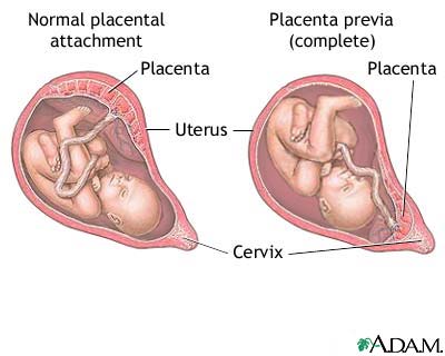 What is a grade 3 placenta?